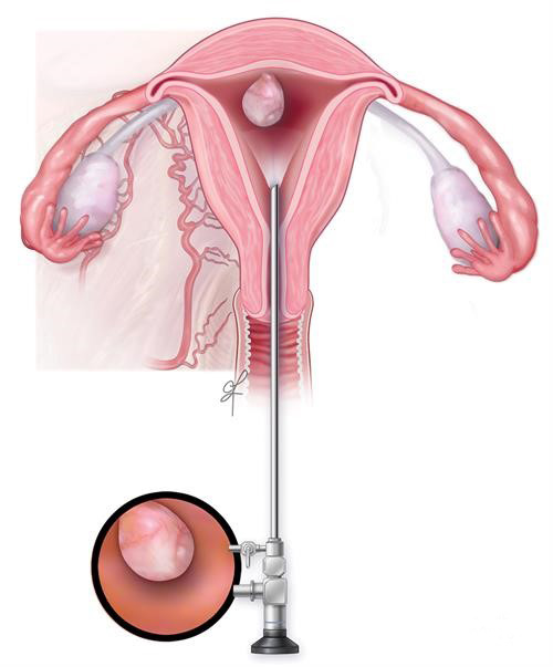 endometriyal polip tedavisi