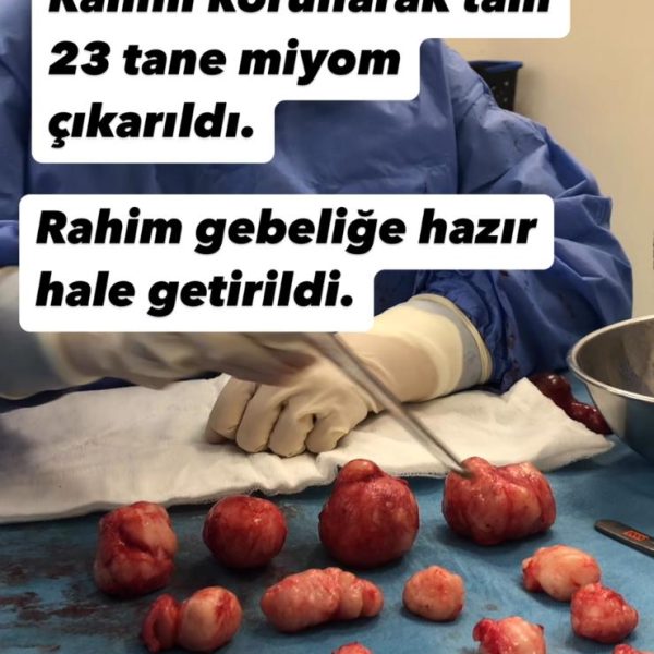 rahim alınmadan miyom ameliyatı.
