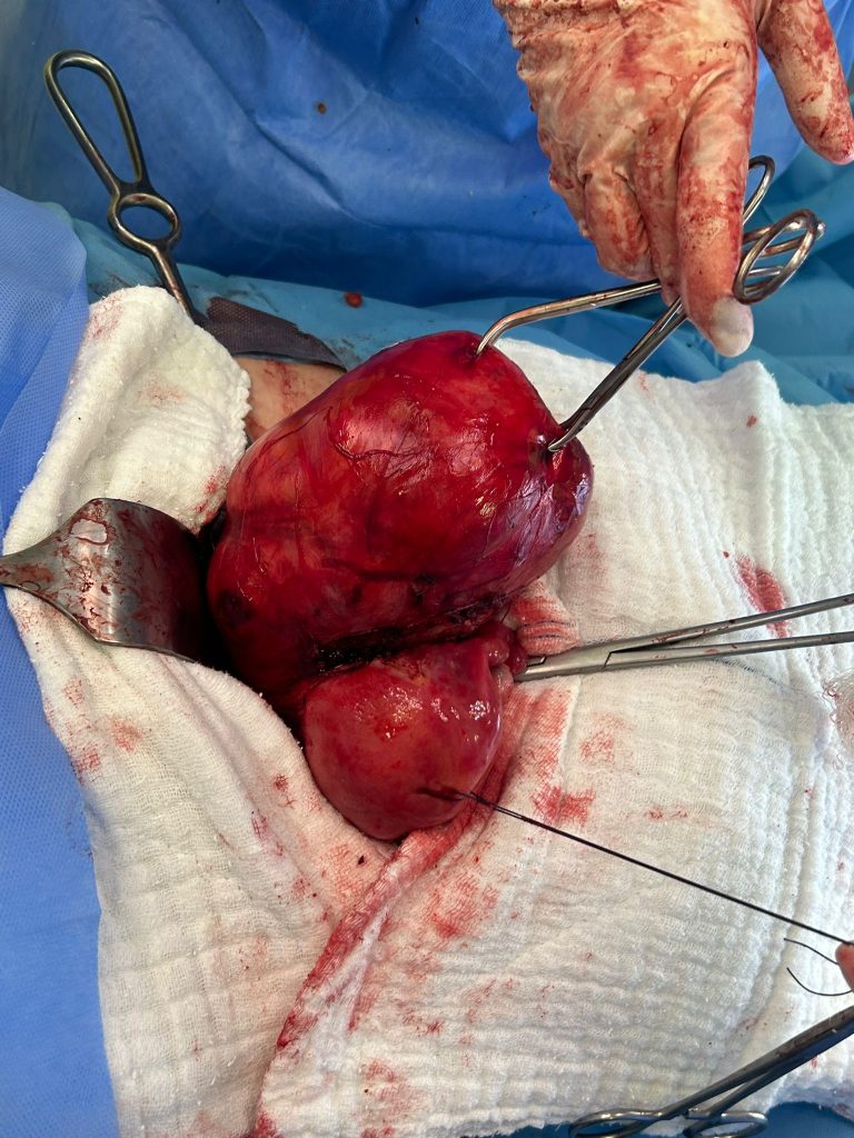 MİYOMLARINIZDAN KURTULUN !!!! RAHİM KORUYCU AMELİYAT İLE RAHMİNİZİN KORUNMASI MÜMKÜN.